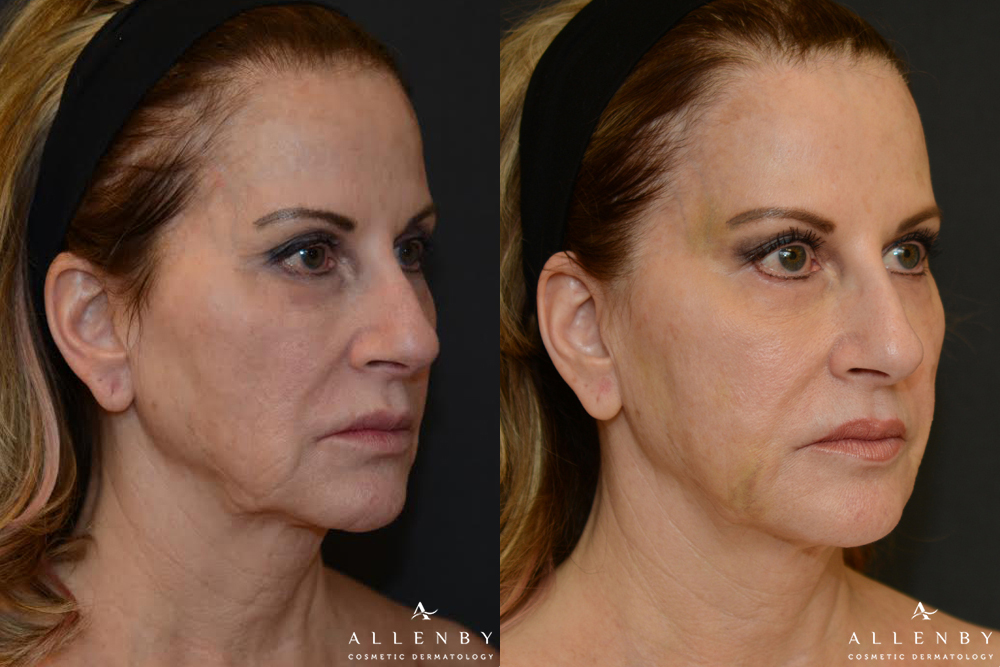 Threadlift Before and After Photo by Allenby Cosmetic Dermatology in Delray Beach, FL