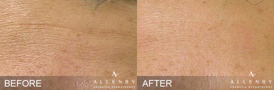 Hydrafacial Before and After Photo by Allenby Cosmetic Dermatology in Delray Beach, FL