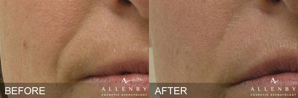 Hydrafacial Before and After Photo by Allenby Cosmetic Dermatology in Delray Beach, FL