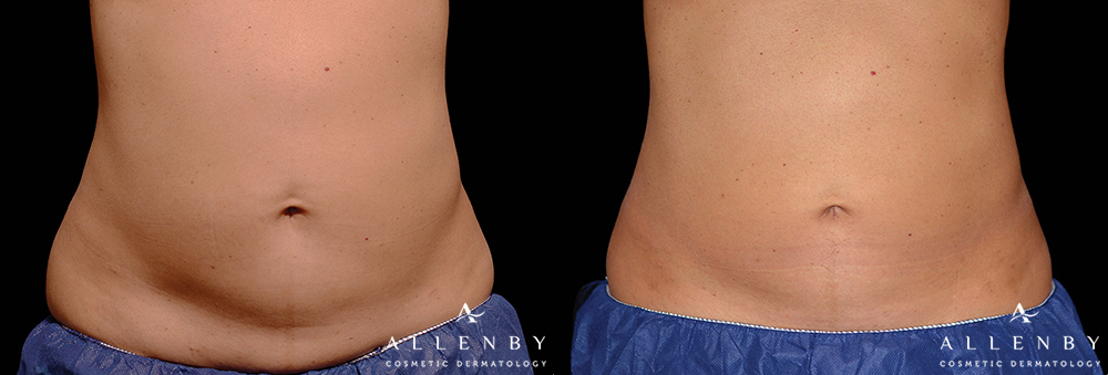 CoolSculpting Before and After Photo by Allenby Cosmetic Dermatology in Delray Beach, FL