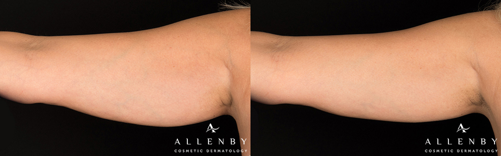 CoolSculpting Before and After Photo by Allenby Cosmetic Dermatology in Delray Beach, FL
