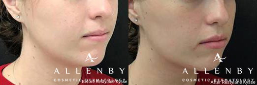 Restylane Kysse Before and After Photo by Allenby Cosmetic Dermatology in Delray Beach, FL