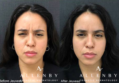 Jeuveau Before and After Photo by Allenby Cosmetic Dermatology in Delray Beach, FL