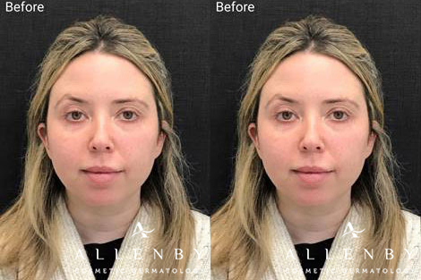 Restylane Kysse Before and After Photo by Allenby Cosmetic Dermatology in Delray Beach, FL