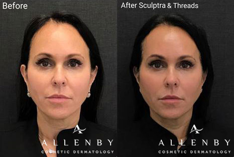Sculptra® Aesthetic, Threadlift Before and After Photo by Allenby Cosmetic Dermatology in Delray Beach, FL