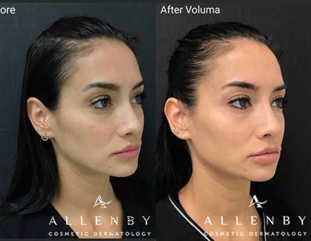 Juvederm Volbella XC Before and After Photo by Allenby Cosmetic Dermatology in Delray Beach, FL