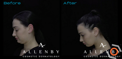 MyEllevate Before and After Photo by Allenby Cosmetic Dermatology in Delray Beach, FL
