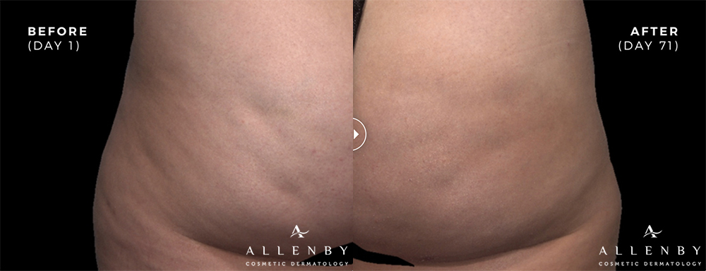 QWO Before and After Photo by Allenby Cosmetic Dermatology in Delray Beach, FL