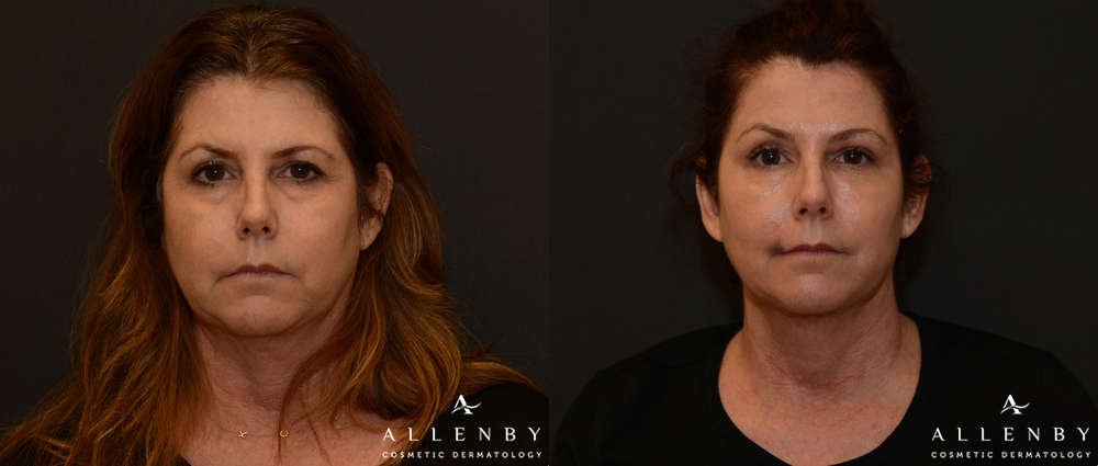 Kybella Before and After Photo by Allenby Cosmetic Dermatology in Delray Beach, FL