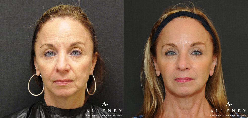 Liquid Facelift Before and After Photo by Allenby Cosmetic Dermatology in Delray Beach, FL
