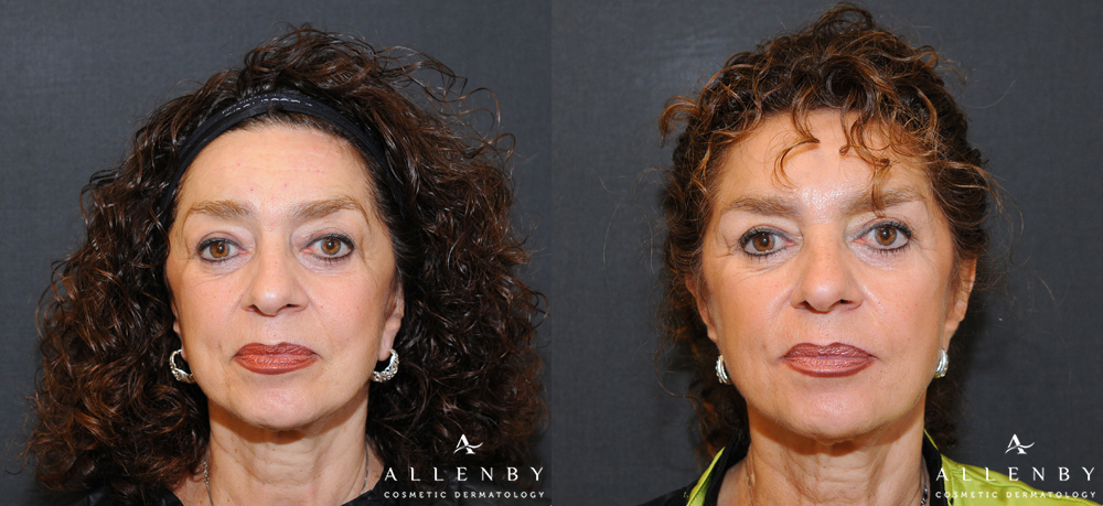 Liquid Facelift Before and After Photo by Allenby Cosmetic Dermatology in Delray Beach, FL