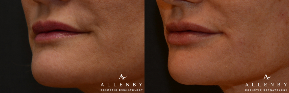 Juvederm Volbella XC Before and After Photo by Allenby Cosmetic Dermatology in Delray Beach, FL