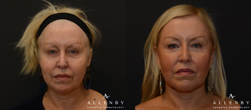 Radio Frequency Before and After Photo by Allenby Cosmetic Dermatology in Delray Beach, FL