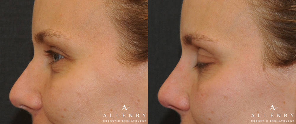 Nose Before and After Photo by Allenby Cosmetic Dermatology in Delray Beach, FL