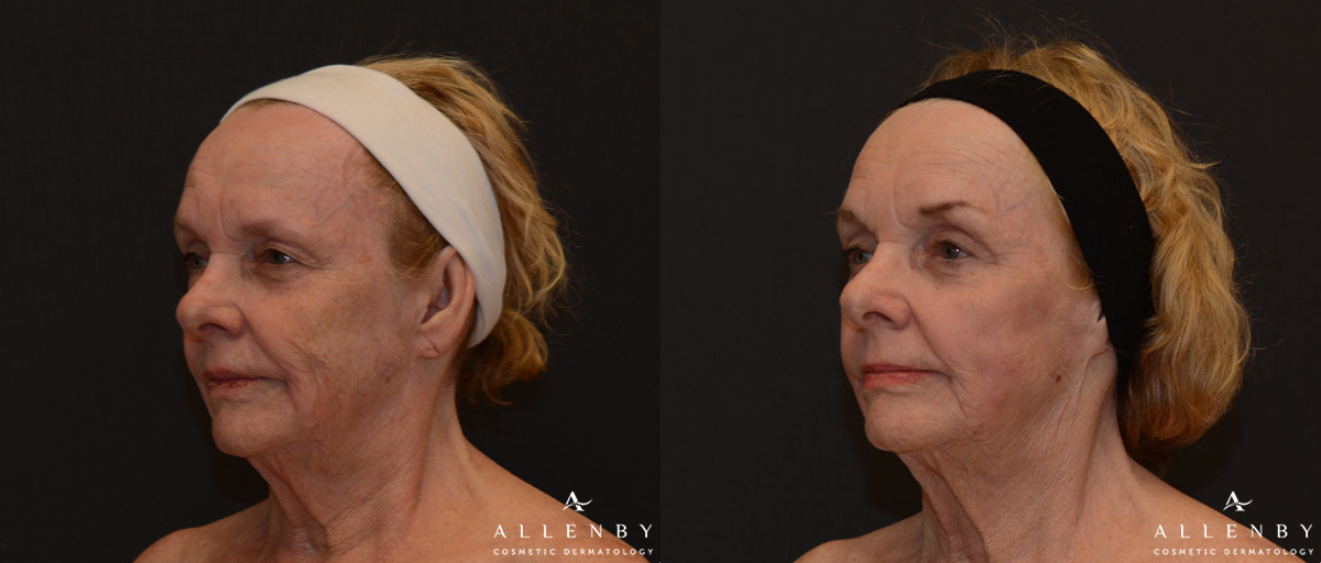 CO2 & Profound, Radio Frequency Before and After Photo by Allenby Cosmetic Dermatology in Delray Beach, FL