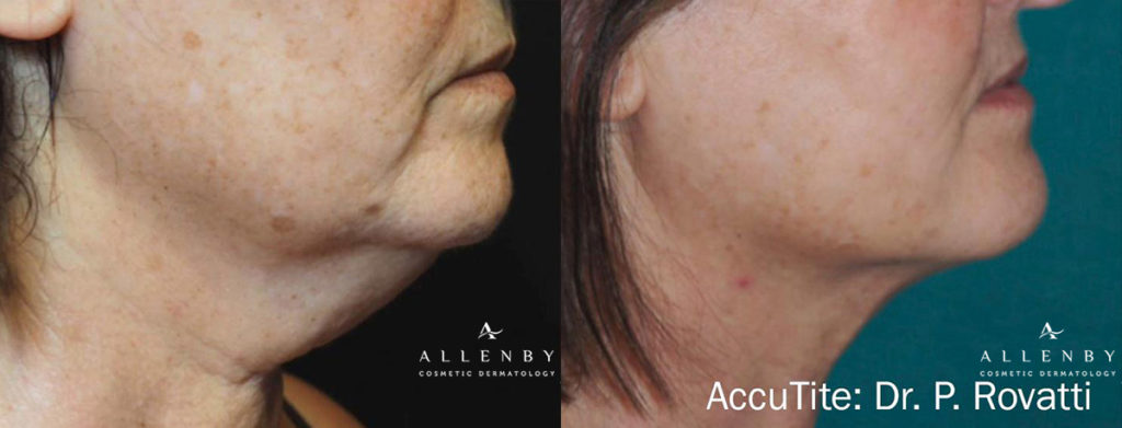 AccuTite Before and After Photo by Allenby Cosmetic Dermatology in Delray Beach, FL