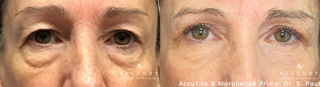 AccuTite Before and After Photo by Allenby Cosmetic Dermatology in Delray Beach, FL