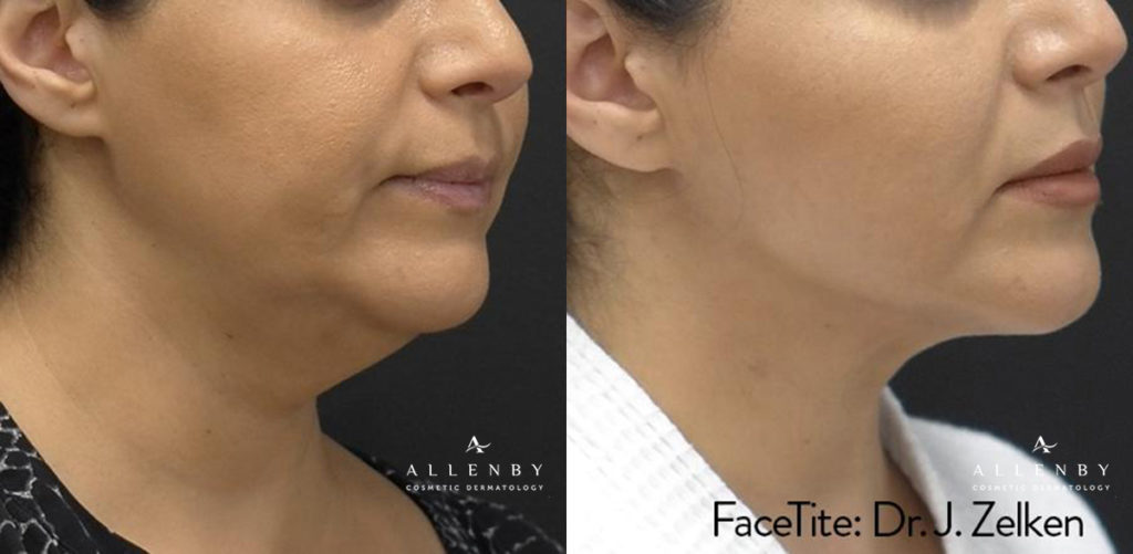 FaceTite Before and After Photo by Allenby Cosmetic Dermatology in Delray Beach, FL