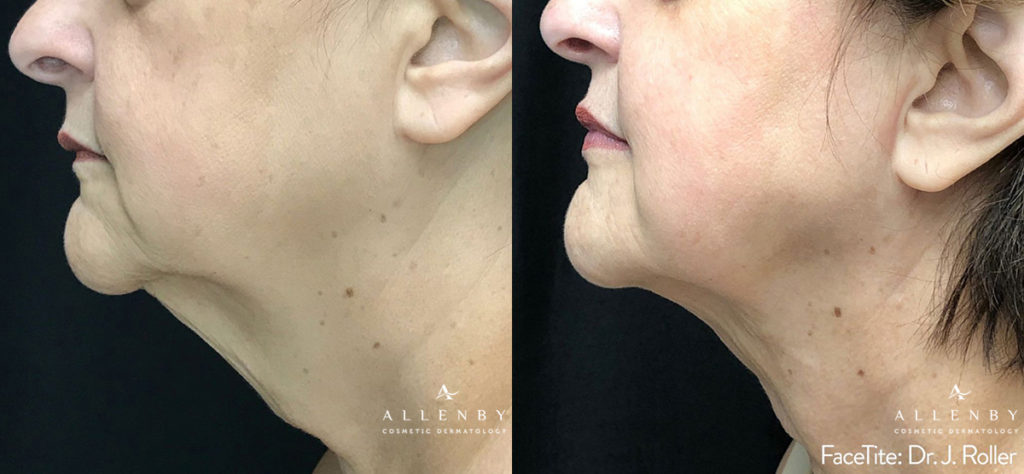 FaceTite Before and After Photo by Allenby Cosmetic Dermatology in Delray Beach, FL