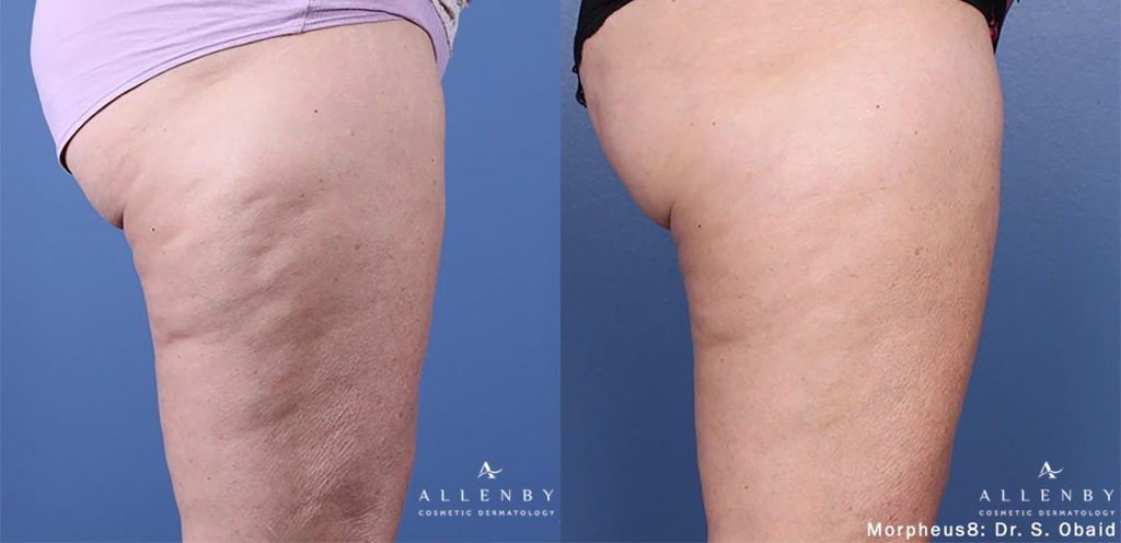 Morpheus8 Body Before and After Photo by Allenby Cosmetic Dermatology in Delray Beach, FL
