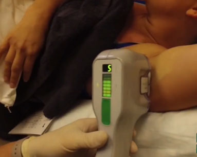 Photo of the MiraDry device in action for over sweating treatment