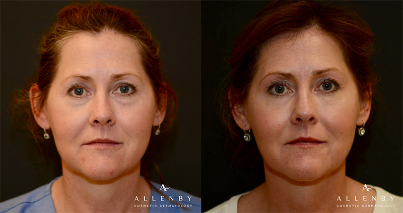 Kybella Before& After