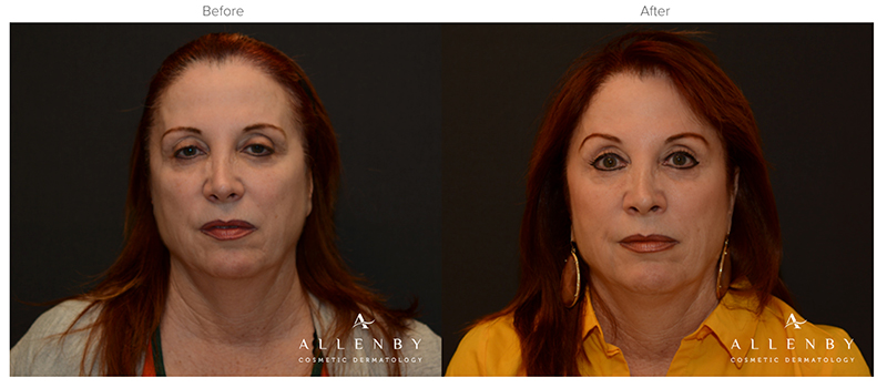 Ultherapy Before & After