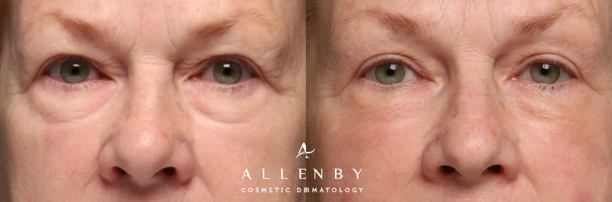 AccuTite, Morpheus8 Before and After Photo by Allenby Cosmetic Dermatology in Delray Beach, FL