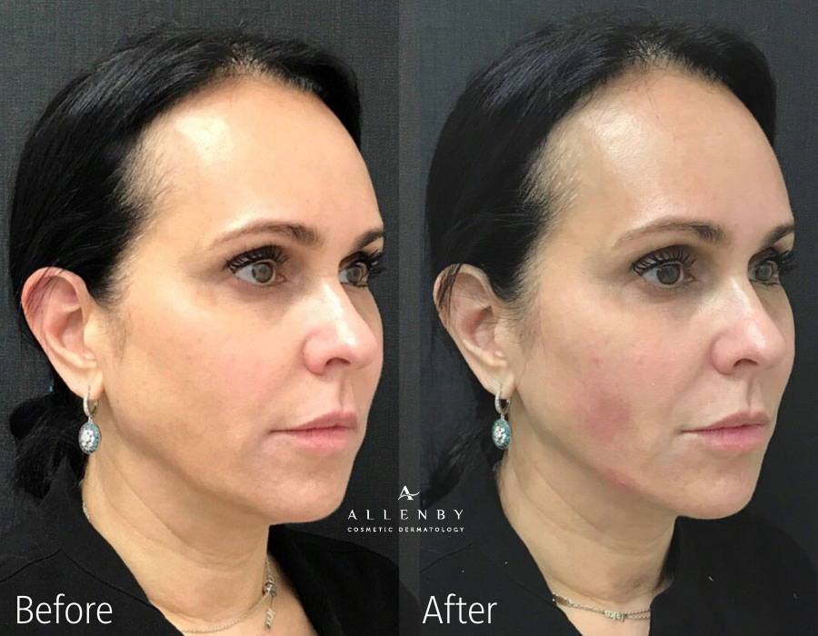 Cheek Filler, Chin Filler, Jaw Line Filler Before and After Photo by Allenby Cosmetic Dermatology in Delray Beach, FL