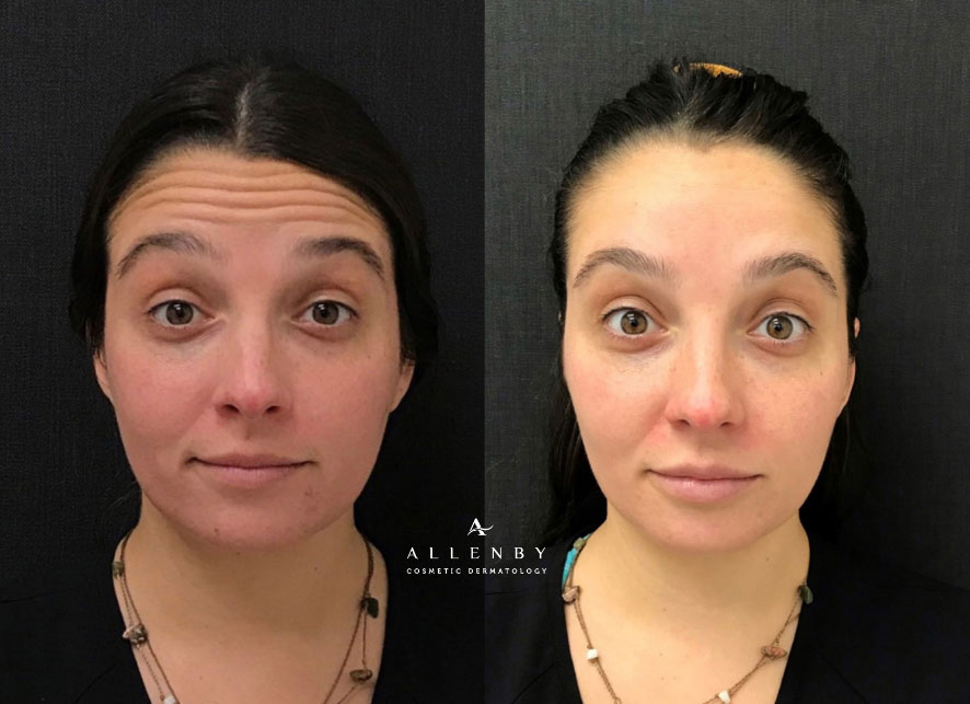 Dysport Before and After Photo by Allenby Cosmetic Dermatology in Delray Beach, FL