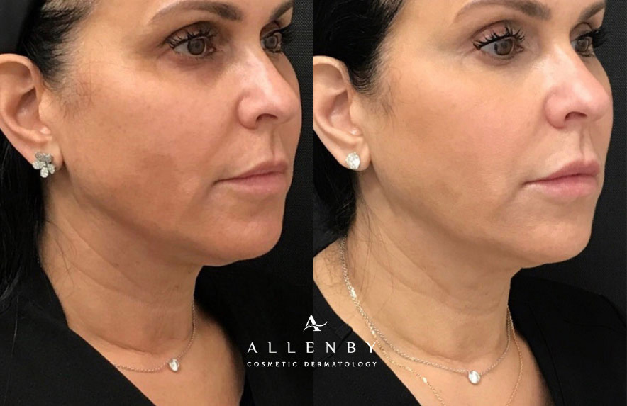 European Peel Before and After Photo by Allenby Cosmetic Dermatology in Delray Beach, FL