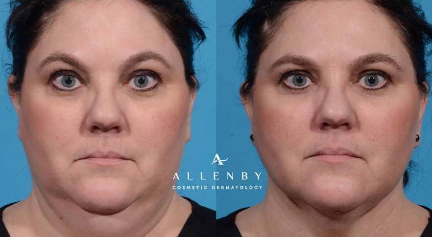 FaceTite, Morpheus8 Before and After Photo by Allenby Cosmetic Dermatology in Delray Beach, FL