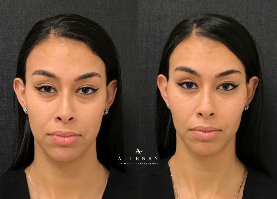 Cheek Filler, Chin Filler Before and After Photo by Allenby Cosmetic Dermatology in Delray Beach, FL