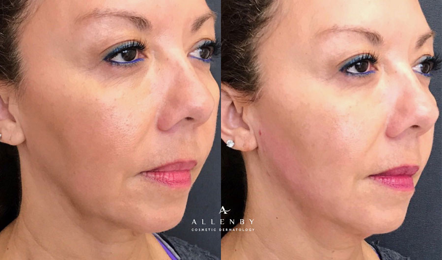 Threadlift Before and After Photo by Allenby Cosmetic Dermatology in Delray Beach, FL