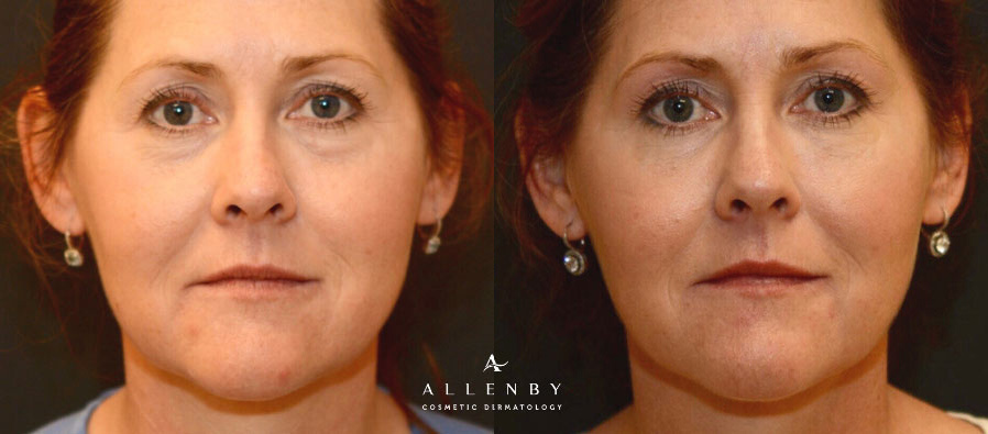 Kybella Under Eye Before and After Photo by Allenby Cosmetic Dermatology in Delray Beach, FL