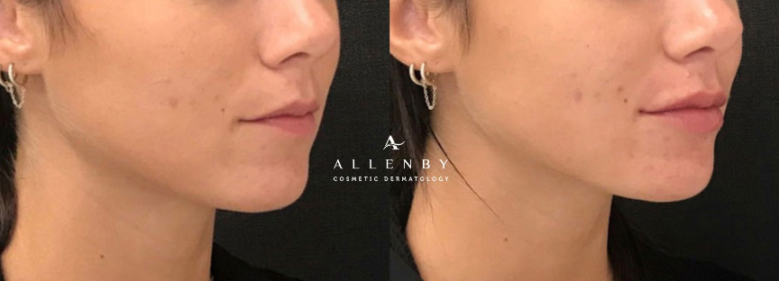 Kysse Before and After Photo by Allenby Cosmetic Dermatology in Delray Beach, FL