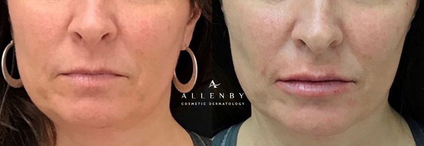 Kysse Before and After Photo by Allenby Cosmetic Dermatology in Delray Beach, FL