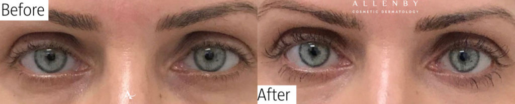 Nu-Cil™ Eyelash Enhancing Serum Before and After Photo by Allenby Cosmetic Dermatology in Delray Beach, FL