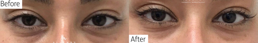 Nu-Cil™ Eyelash Enhancing Serum Before and After Photo by Allenby Cosmetic Dermatology in Delray Beach, FL