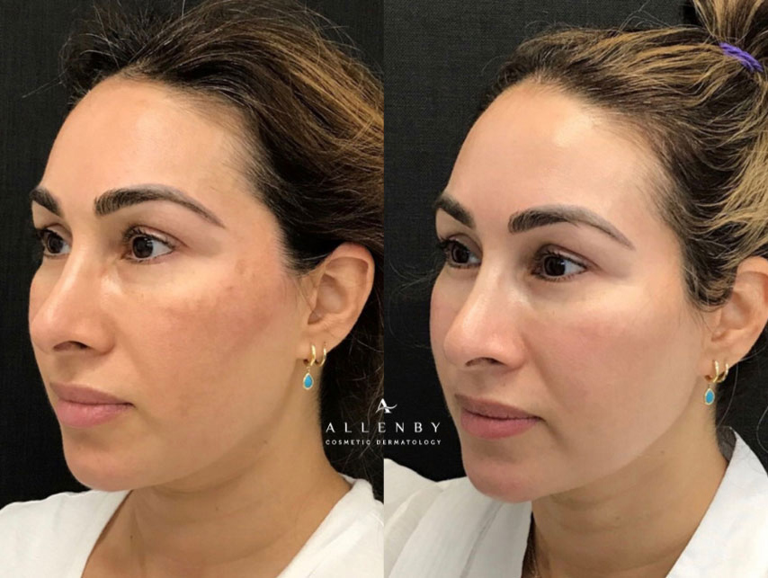 Obagi Nu-Derm Before and After Photo by Allenby Cosmetic Dermatology in Delray Beach, FL