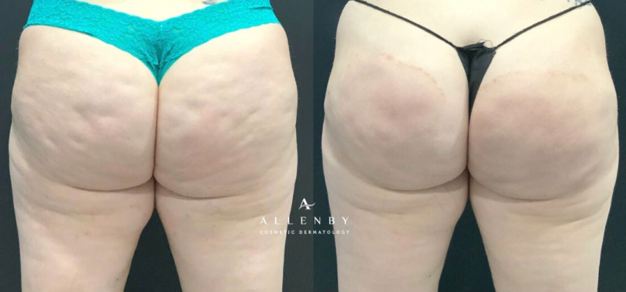 QWO Before and After Photo by Allenby Cosmetic Dermatology in Delray Beach, FL