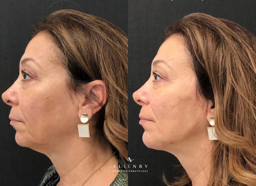 Restylane Lyft Before and After Photo by Allenby Cosmetic Dermatology in Delray Beach, FL