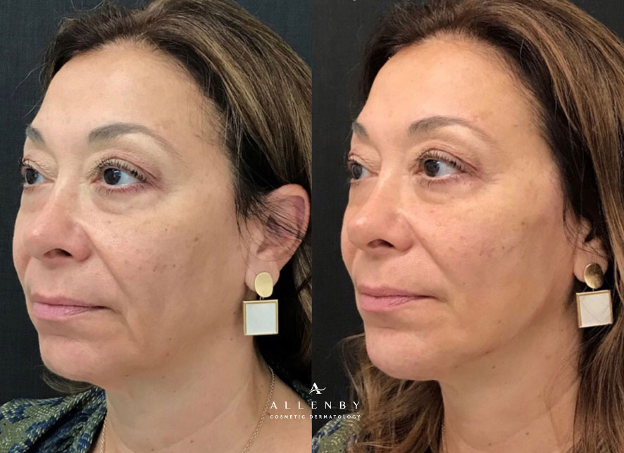 Restylane Lyft Before and After Photo by Allenby Cosmetic Dermatology in Delray Beach, FL