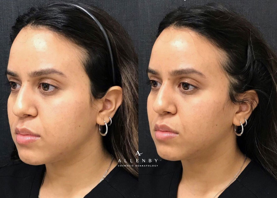 Sculptra® Aesthetic Before and After Photo by Allenby Cosmetic Dermatology in Delray Beach, FL