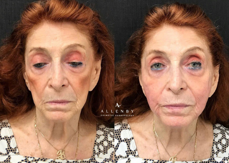Sculptra® Aesthetic, Threadlift Before and After Photo by Allenby Cosmetic Dermatology in Delray Beach, FL