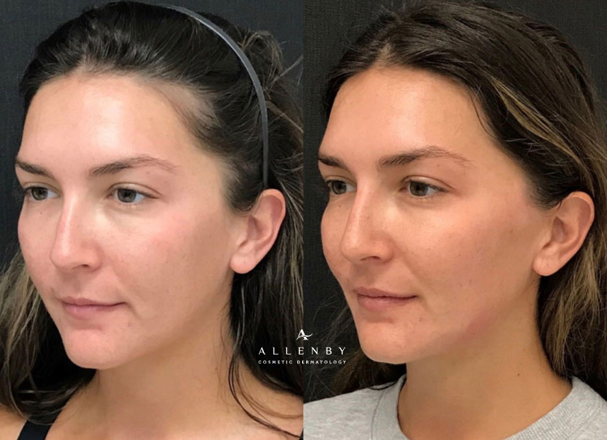 Sculptra® Aesthetic Before and After Photo by Allenby Cosmetic Dermatology in Delray Beach, FL