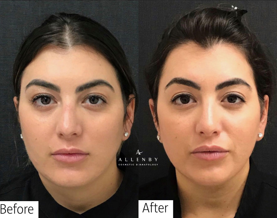 Cheek Filler, Jaw Line Filler, Threadlift Before and After Photo by Allenby Cosmetic Dermatology in Delray Beach, FL