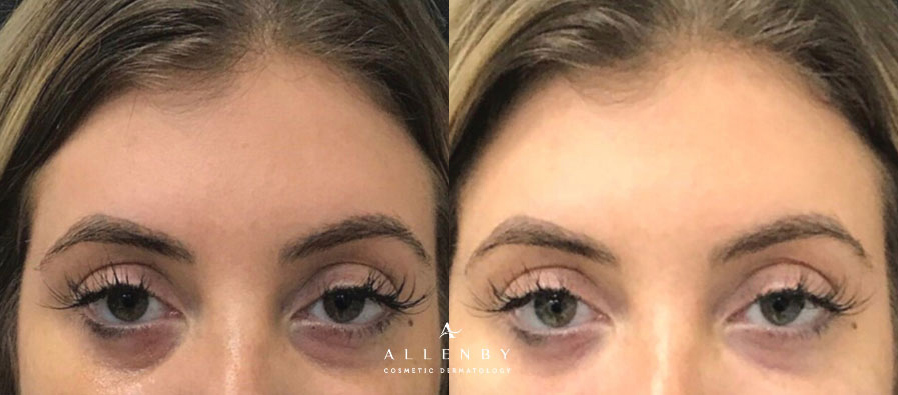 Under Eye Filler Before and After Photo by Allenby Cosmetic Dermatology in Delray Beach, FL