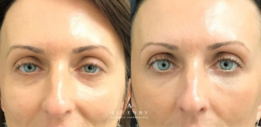 Under Eye Filler Before and After Photo by Allenby Cosmetic Dermatology in Delray Beach, FL