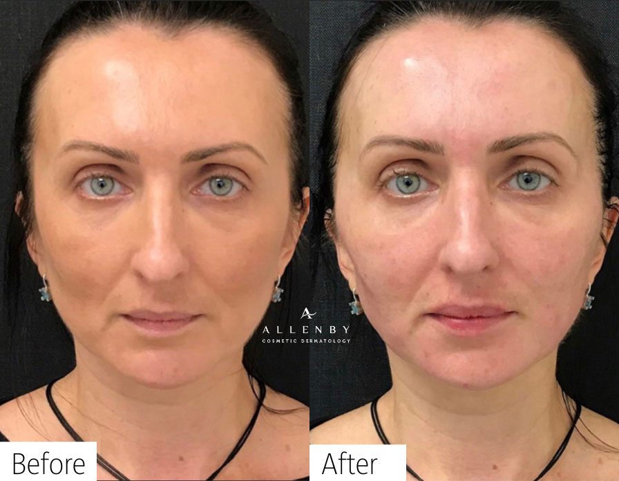 Sculptra® Aesthetic, Versa Before and After Photo by Allenby Cosmetic Dermatology in Delray Beach, FL